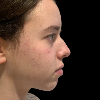 preservation-rhinoplasty-before